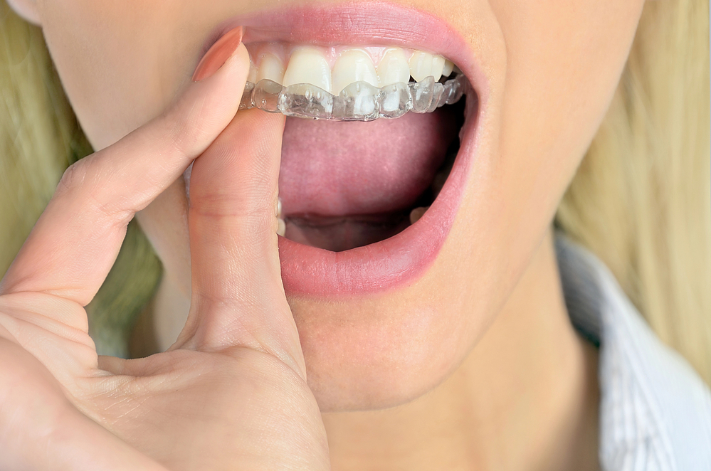 do mouth guards help with snoring